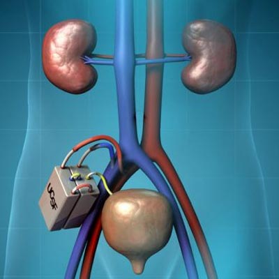 artificial kidney